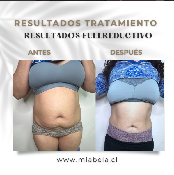 Antes y después tratamiento Full Reductivo — caso 1
