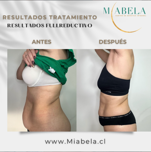 Antes y después tratamiento Full Reductivo — caso 2