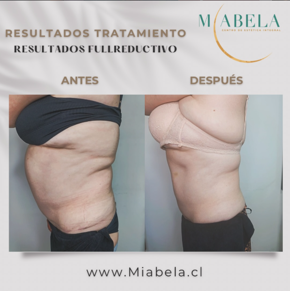 Antes y después tratamiento Full Reductivo — caso 3