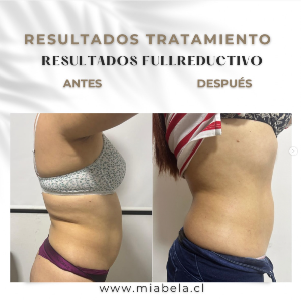Antes y después tratamiento Full Reductivo — caso 4