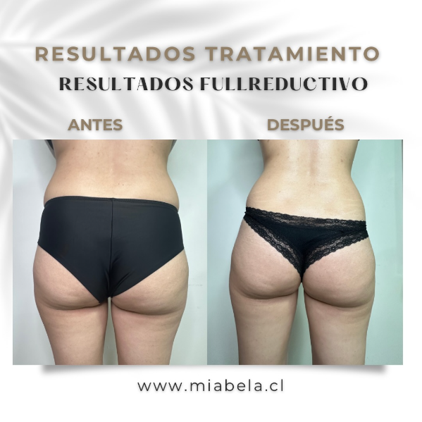 Antes y después tratamiento Full Reductivo — caso 5